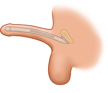 ZSI 100 FTM Malleable Implant for Neopenis