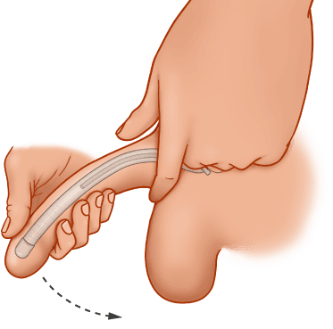 ZSI 100 FTM Malleable Implant for Neopenis