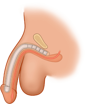 ZSI 100 Malleable Penile Implant