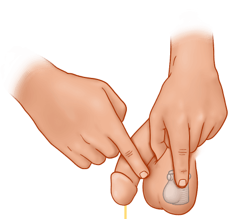 ZSI 375 PF Artificial Urinary Sphincter