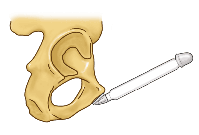 ZSI 475 FTM Inflatable Implant for Neopenis