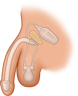 ZSI 475 FTM Inflatable Implant for Neopenis