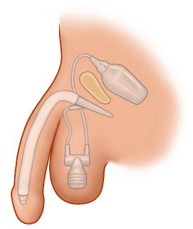 ZSI 475 Inflatable Penile Implant