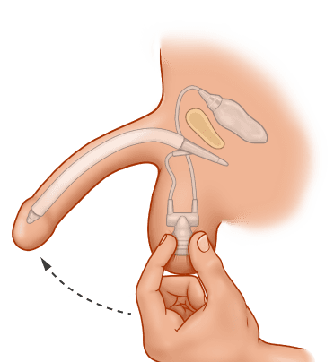 ZSI 475 Inflatable Penile Implant
