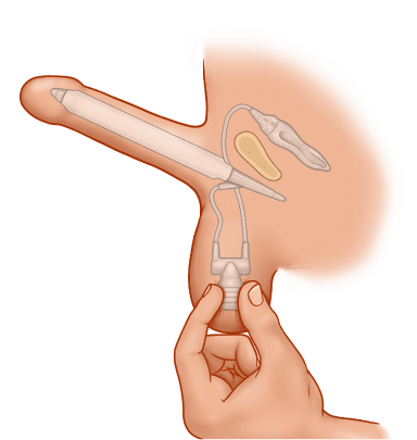 ZSI 475 Inflatable Penile Implant
