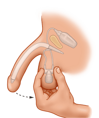 ZSI 475 Inflatable Penile Implant